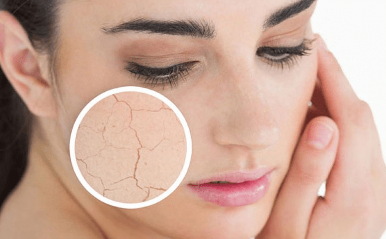 Hỏi-Đáp: Tại sao ngồi máy lạnh bị đau đầu? 5 Da khô